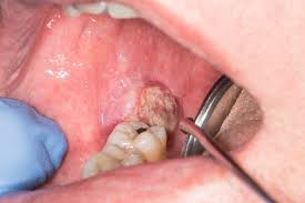 Oral Cavity Cancer